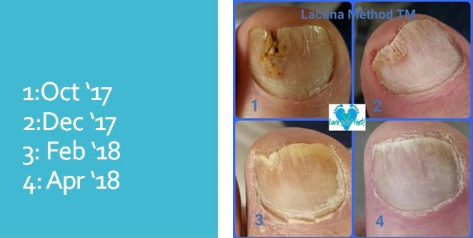 Fungal nail treatment. The Lacuna Method 2