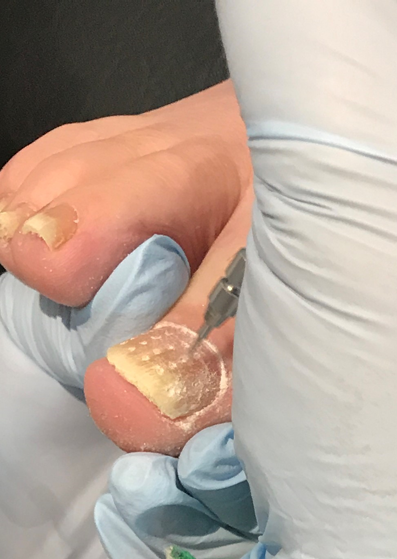 Fungal nail treatment. The Lacuna Method