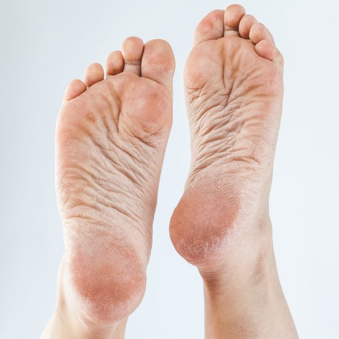 dehydrated-skin-female-heels